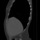 Adrenal metastasis and skeletal metastasis of pulmonary carcinoma, correlation, initial examination: CT - Computed tomography